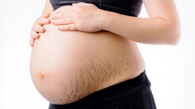 Tempat Langganan Muncul Stretch Mark Saat Hamil